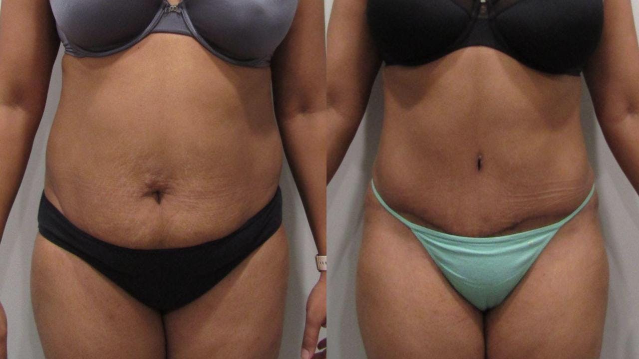 Tummy Tuck Before & After Gallery - Patient 175075310 - Image 1