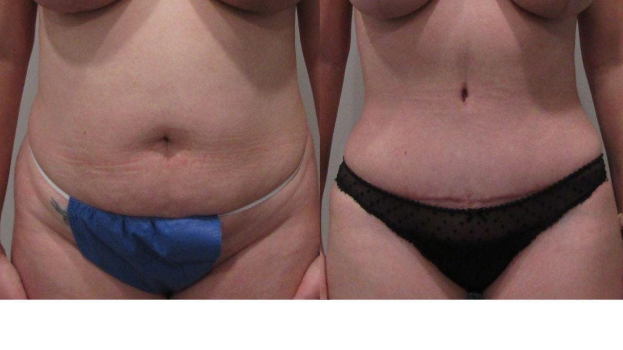 Tummy Tuck Before & After Gallery - Patient 175075311 - Image 1