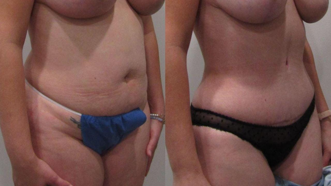 Tummy Tuck Before & After Gallery - Patient 175075311 - Image 2