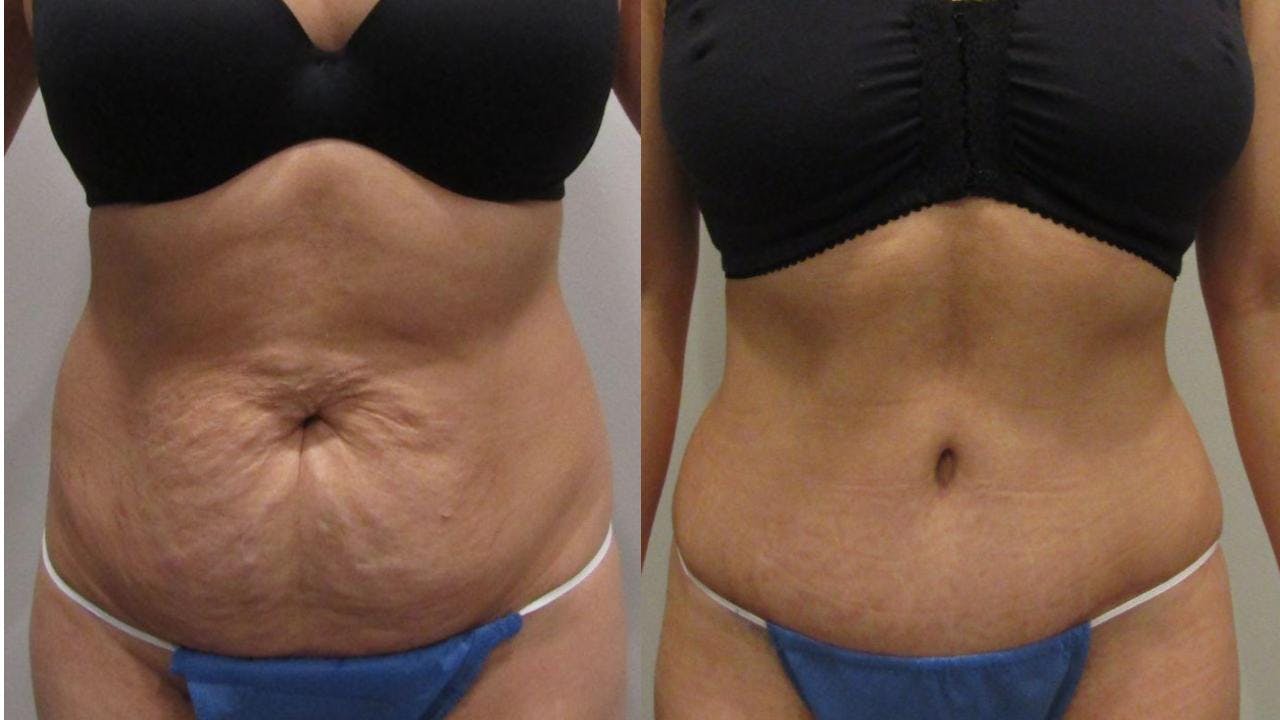 Tummy Tuck Before & After Gallery - Patient 175075312 - Image 1