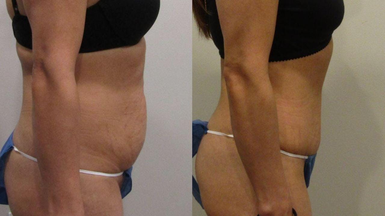 Tummy Tuck Before & After Gallery - Patient 175075312 - Image 2