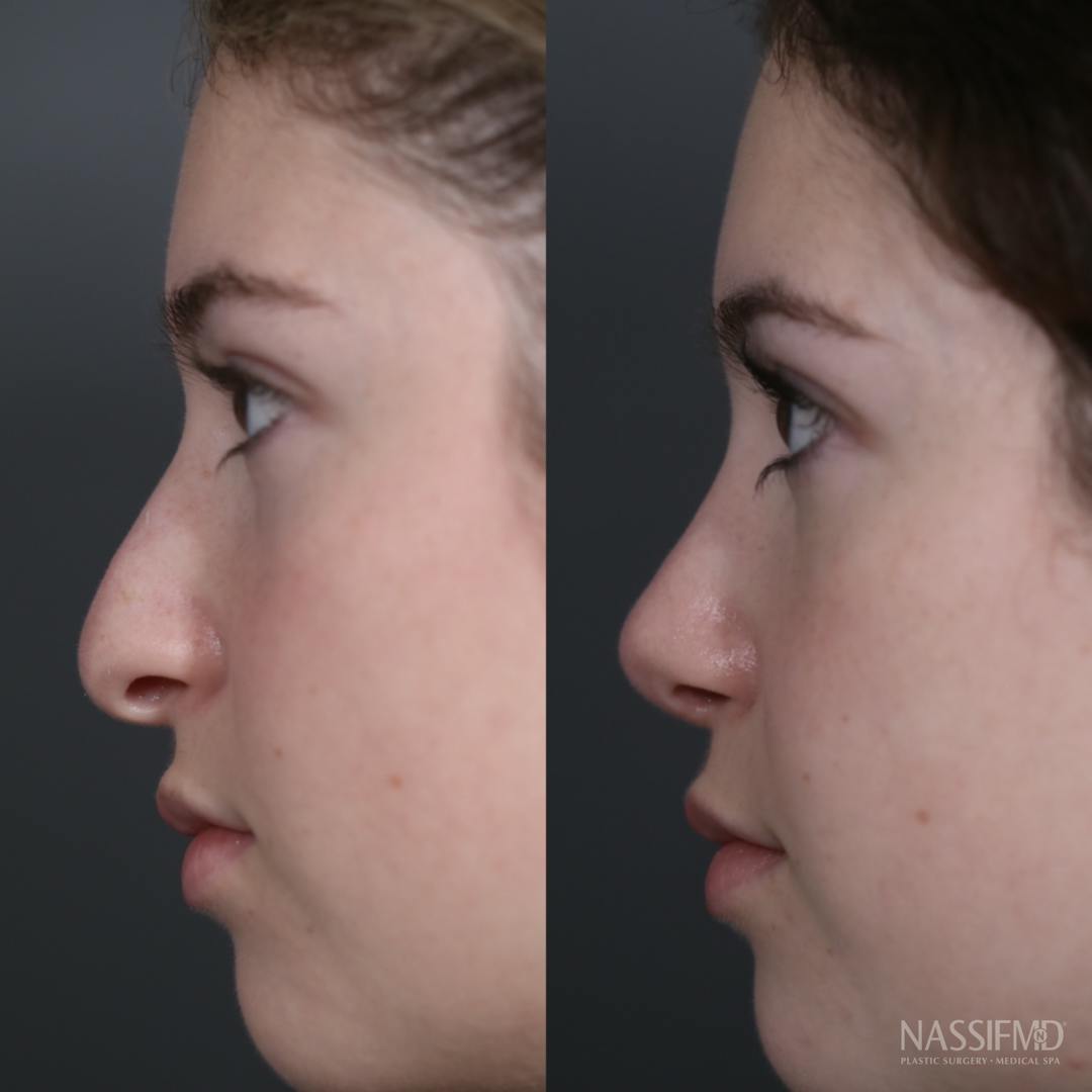 Primary Rhinoplasty Before & After Gallery - Patient 179756837 - Image 3
