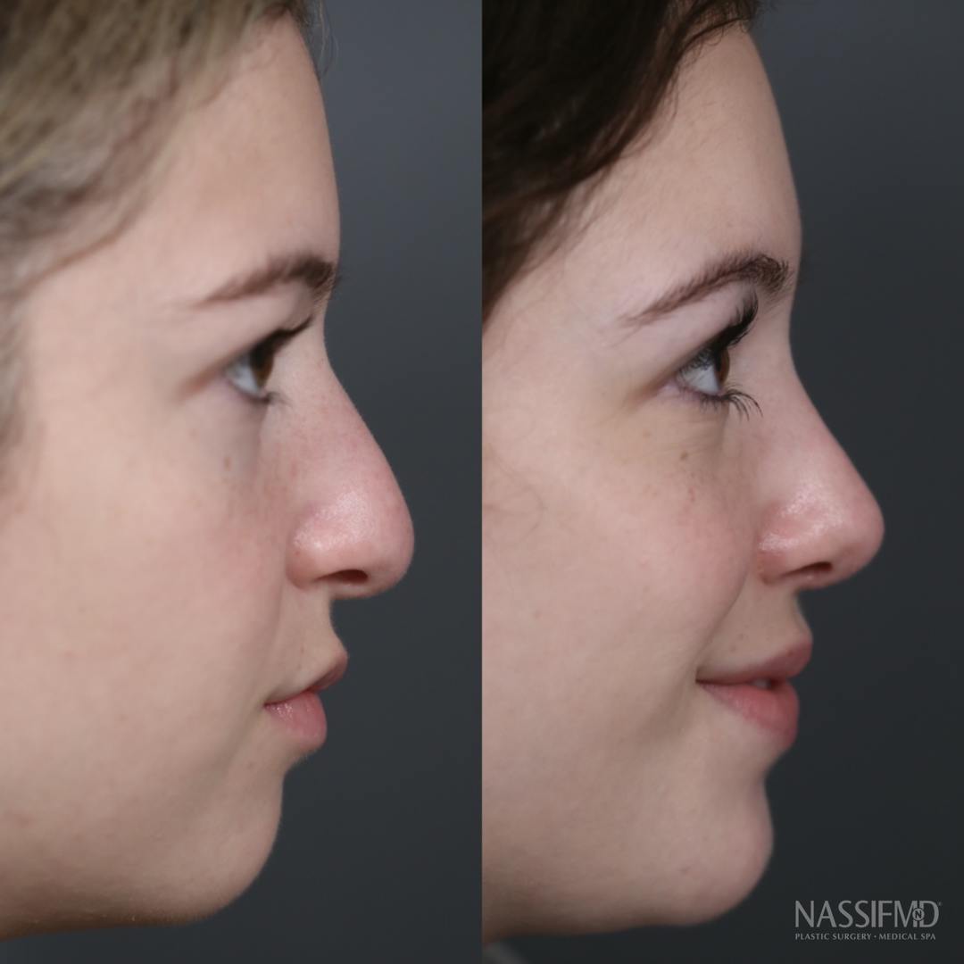 Primary Rhinoplasty Before & After Gallery - Patient 179756837 - Image 1