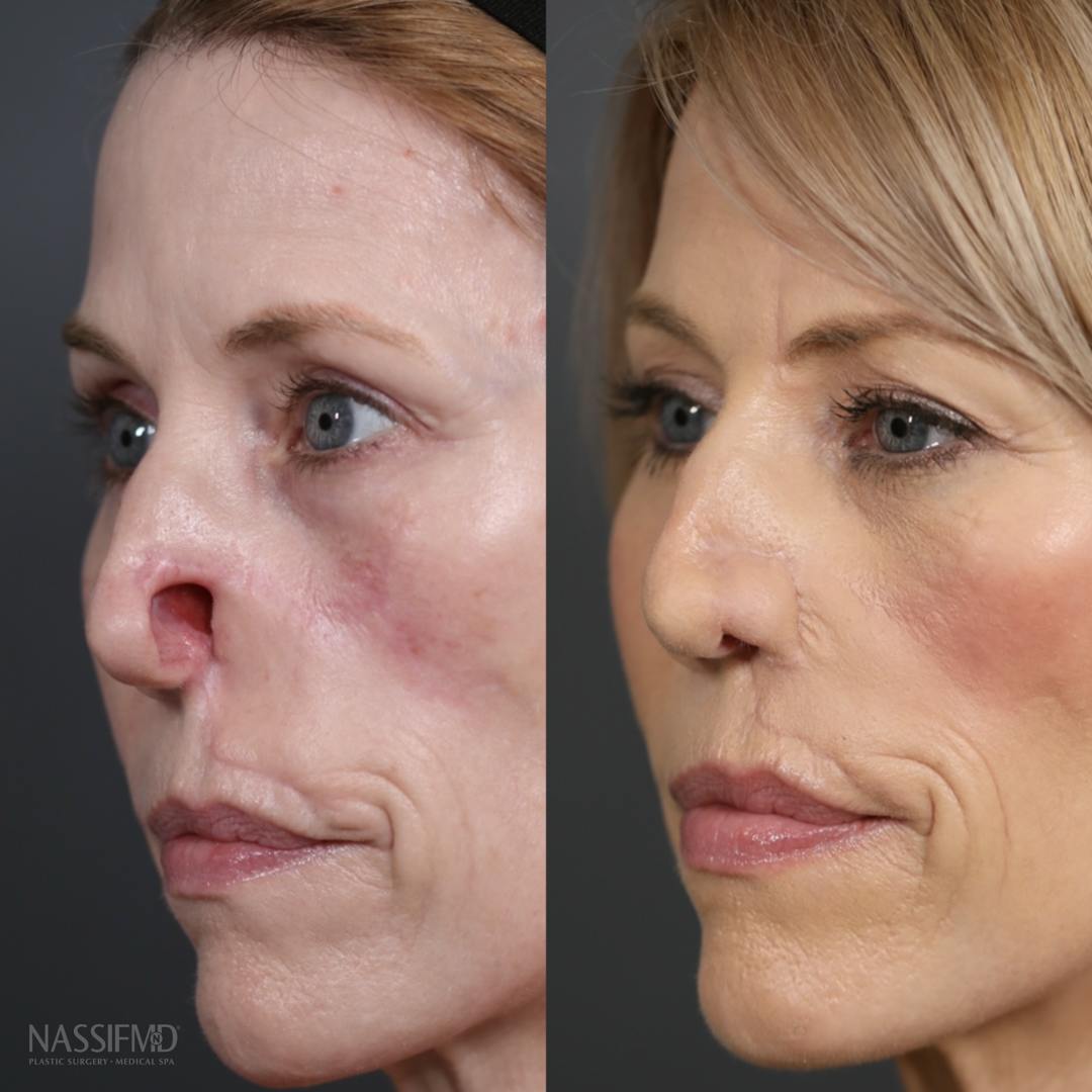 Revision Rhinoplasty Before & After Gallery - Patient 152548 - Image 1