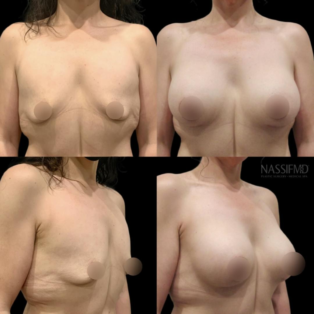 Breast Lift Before & After Gallery - Patient 378650 - Image 1