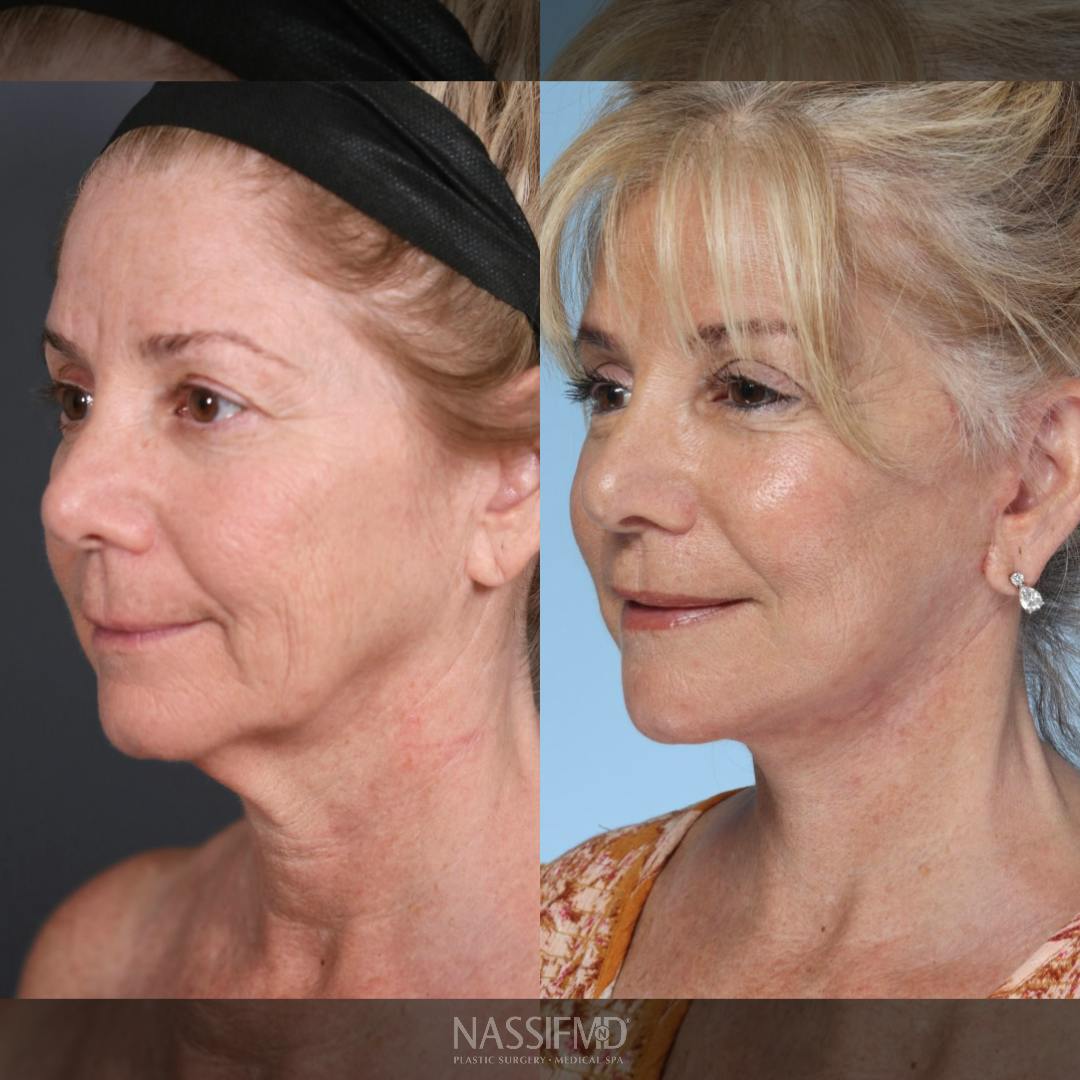 Neck Lift Before & After Gallery - Patient 263699 - Image 4
