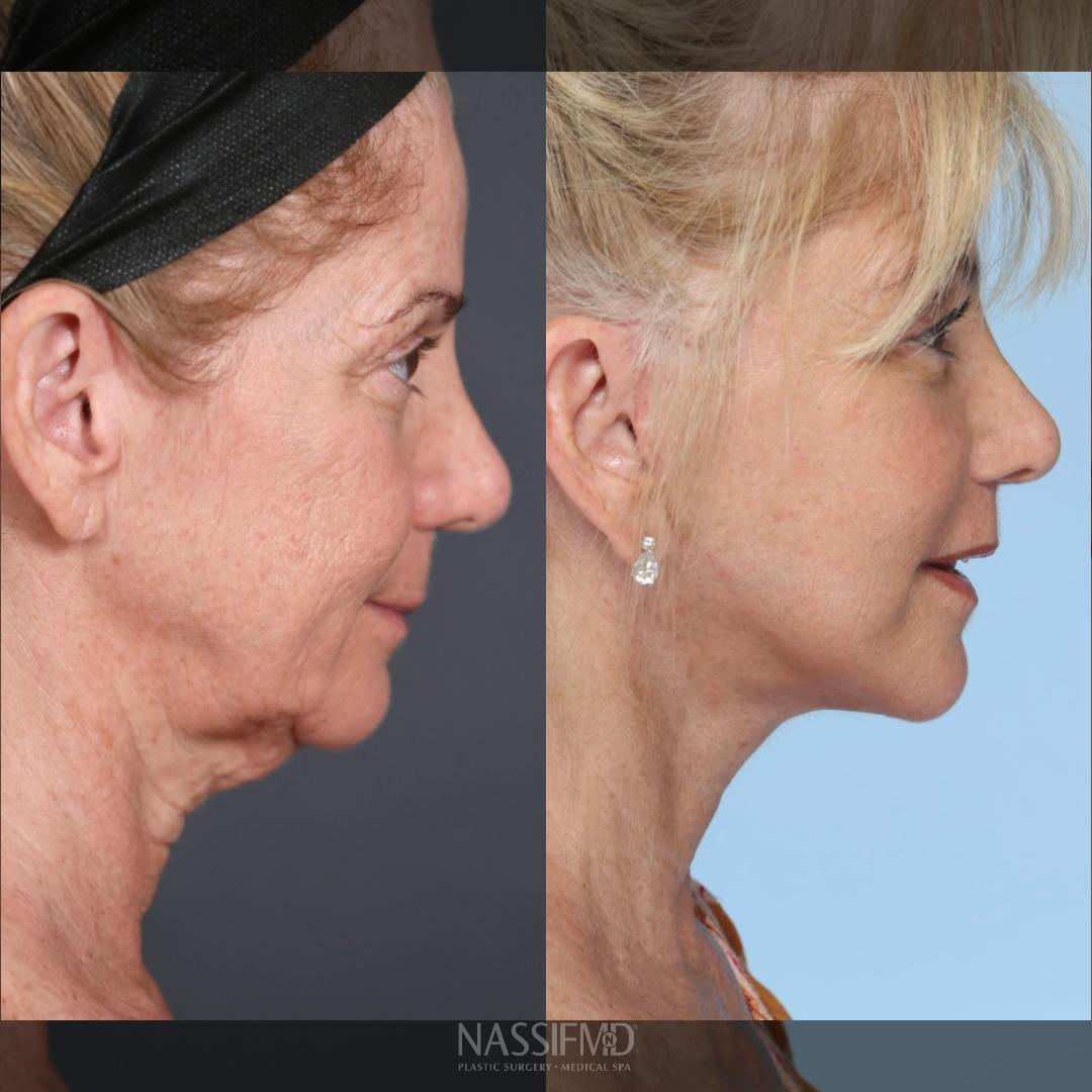 Neck Lift Before & After Gallery - Patient 263699 - Image 3