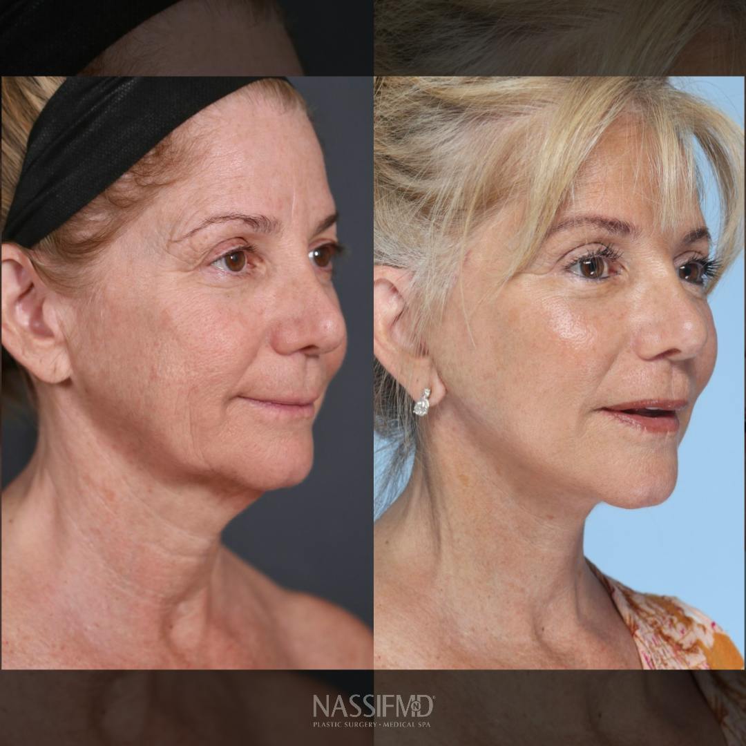 Neck Lift Before & After Gallery - Patient 263699 - Image 2