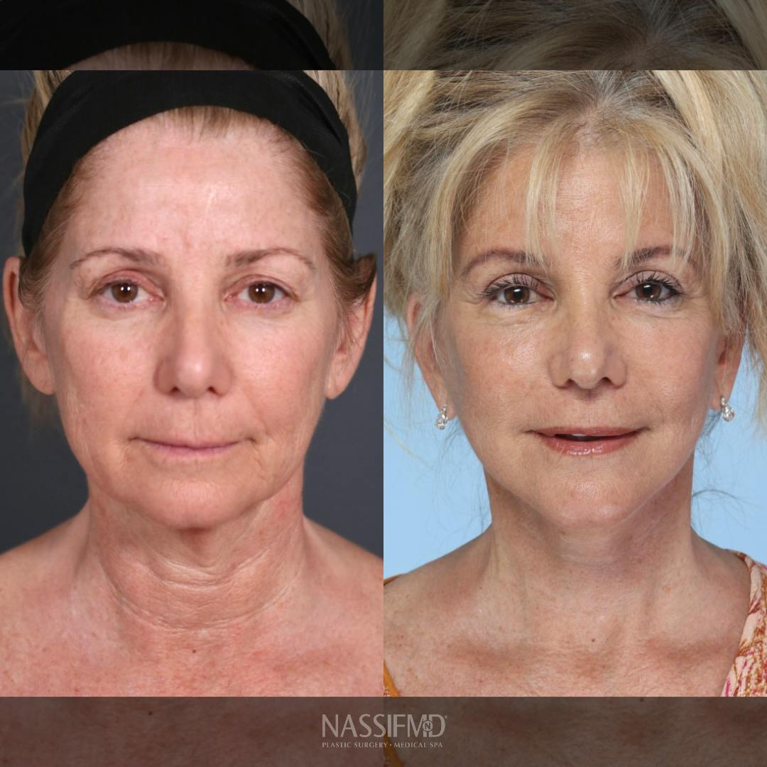 Neck Lift Before & After Gallery - Patient 263699 - Image 1