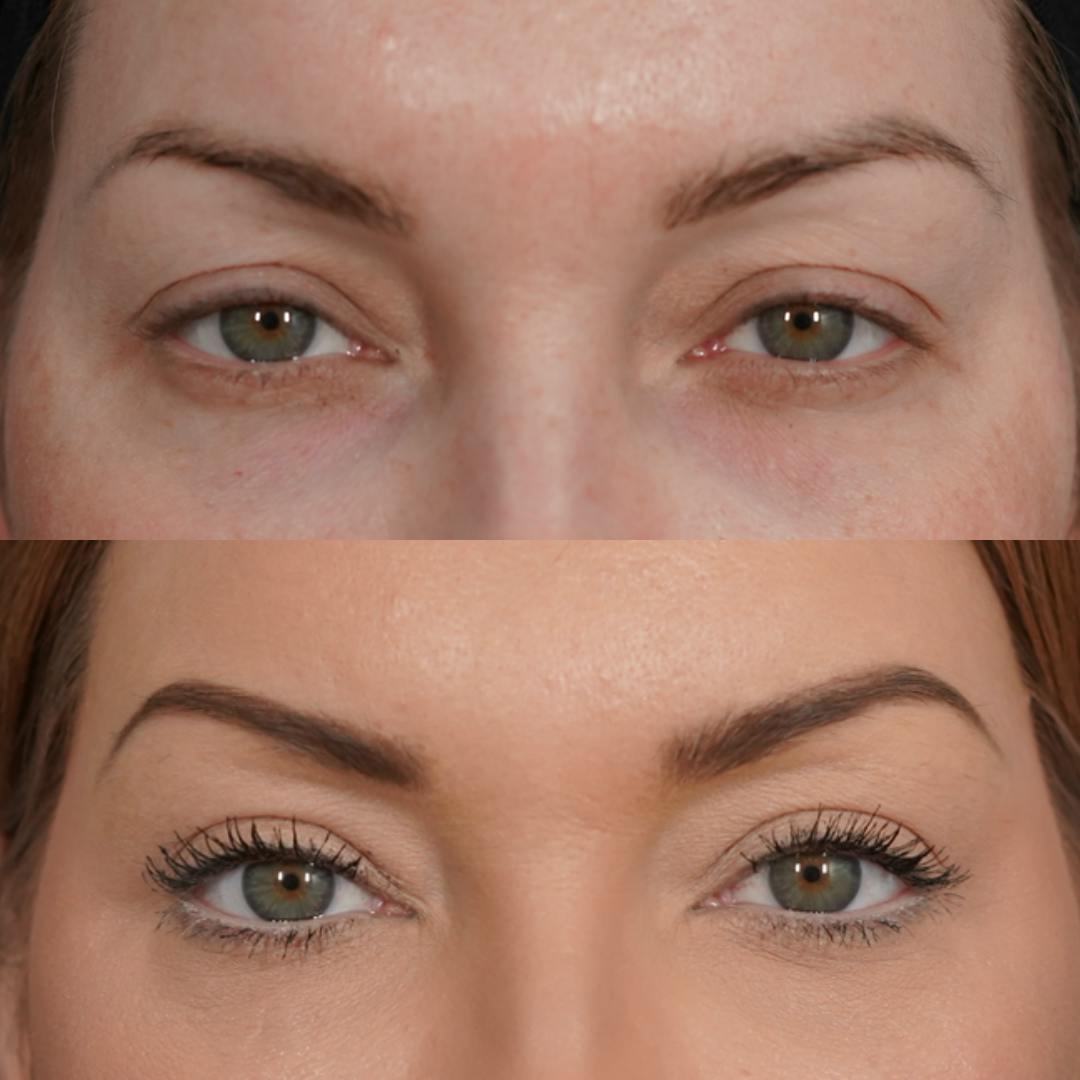 Upper Blepharoplasty Before & After Gallery - Patient 652755 - Image 1