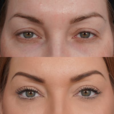 Upper Blepharoplasty Before & After Gallery - Patient 652755 - Image 1