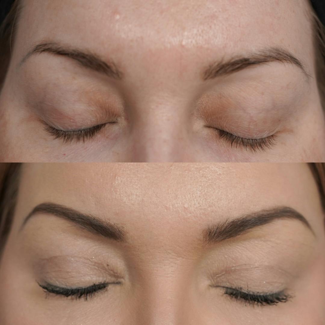 Upper Blepharoplasty Before & After Gallery - Patient 652755 - Image 4