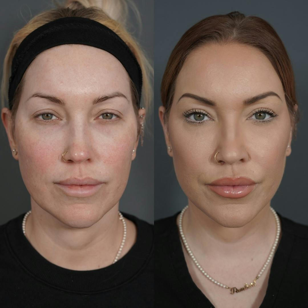 Upper Blepharoplasty Before & After Gallery - Patient 652755 - Image 2