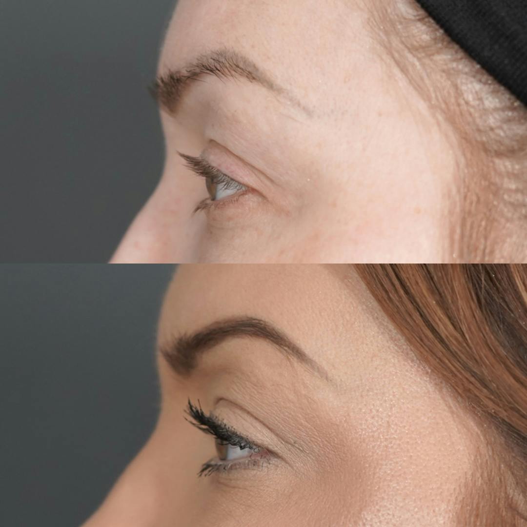 Upper Blepharoplasty Before & After Gallery - Patient 652755 - Image 3