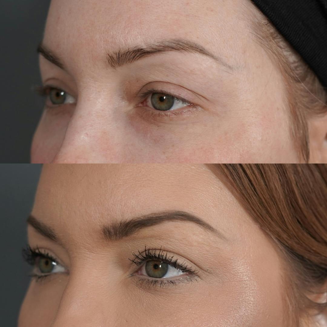 Upper Blepharoplasty Before & After Gallery - Patient 652755 - Image 6