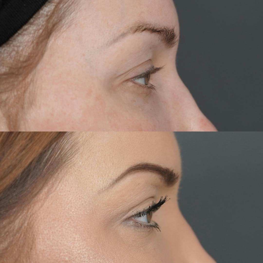 Upper Blepharoplasty Before & After Gallery - Patient 652755 - Image 7