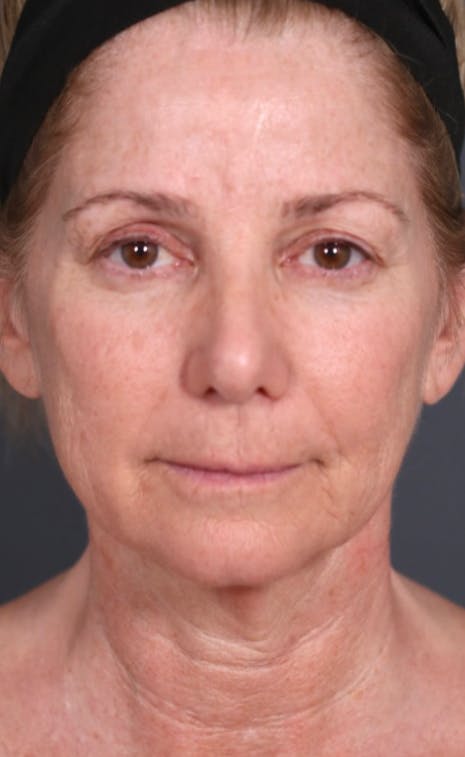Neck Lift Before & After Gallery - Patient 263699 - Image 1