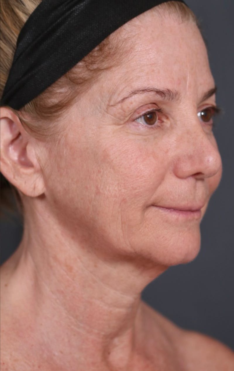 Facelift Before & After Gallery - Patient 214519 - Image 3