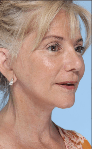 Facelift Before & After Gallery - Patient 214519 - Image 4