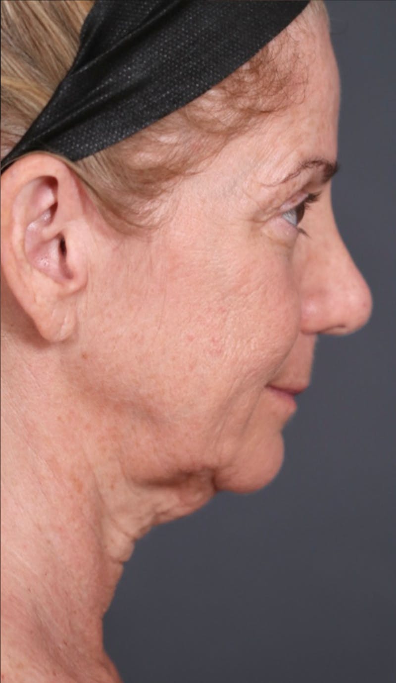 Facelift Before & After Gallery - Patient 214519 - Image 5