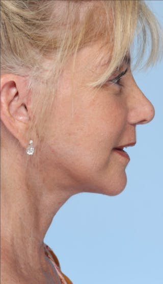 Facelift Before & After Gallery - Patient 214519 - Image 6