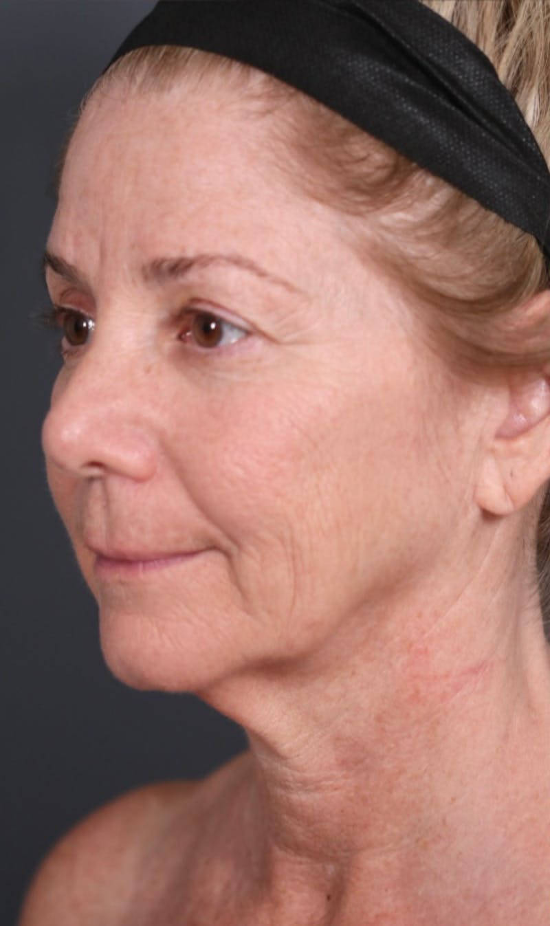 Facelift Before & After Gallery - Patient 214519 - Image 7