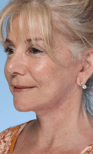 Facelift Before & After Gallery - Patient 214519 - Image 8
