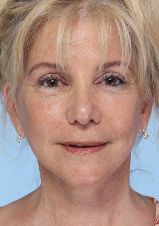 Facelift Before & After Gallery - Patient 214519 - Image 2