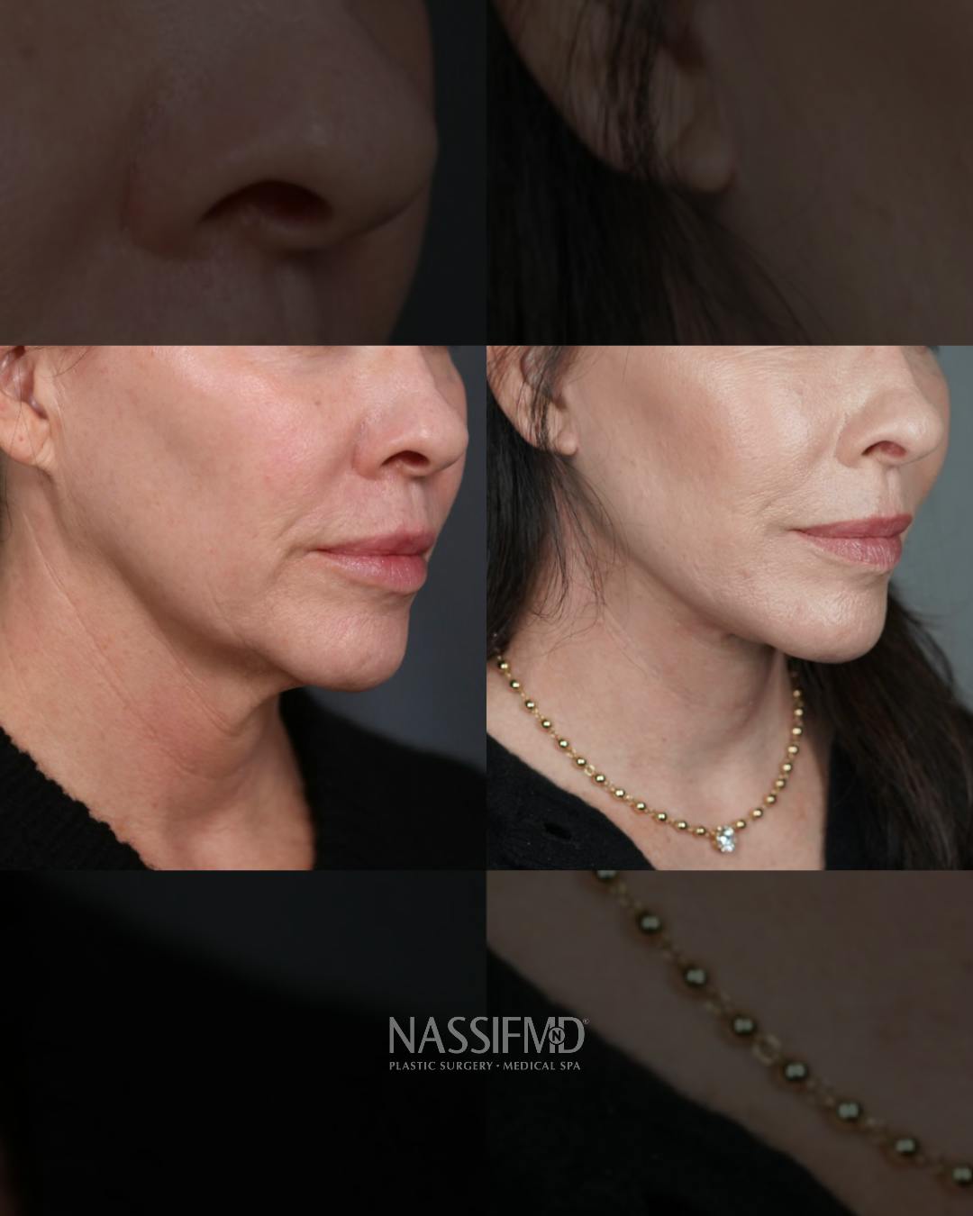 Neck Lift Before & After Gallery - Patient 279023 - Image 1