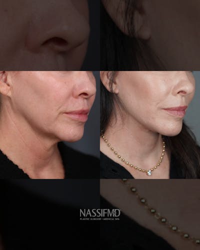 Neck Lift Before & After Gallery - Patient 279023 - Image 1