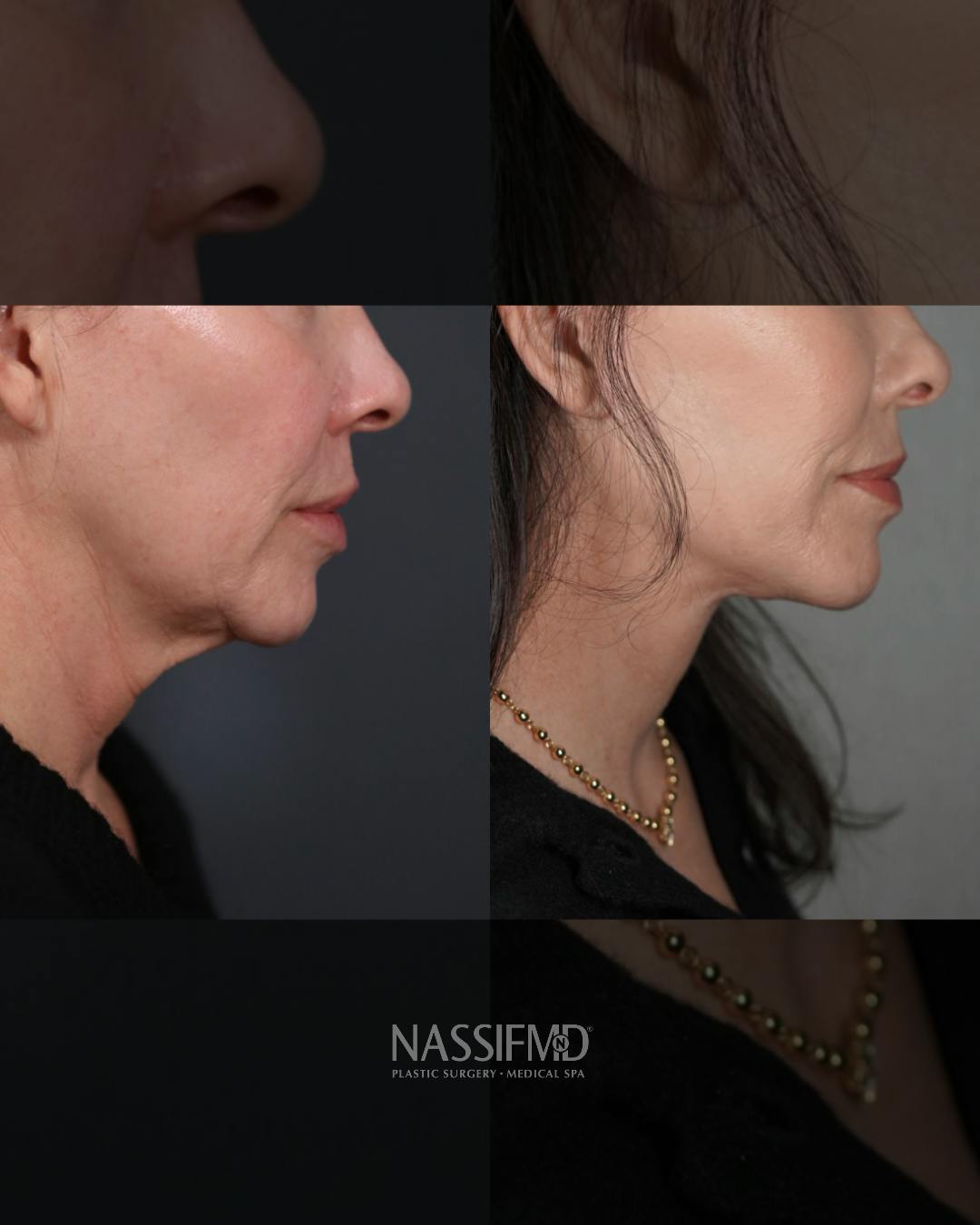 Neck Lift Before & After Gallery - Patient 279023 - Image 2