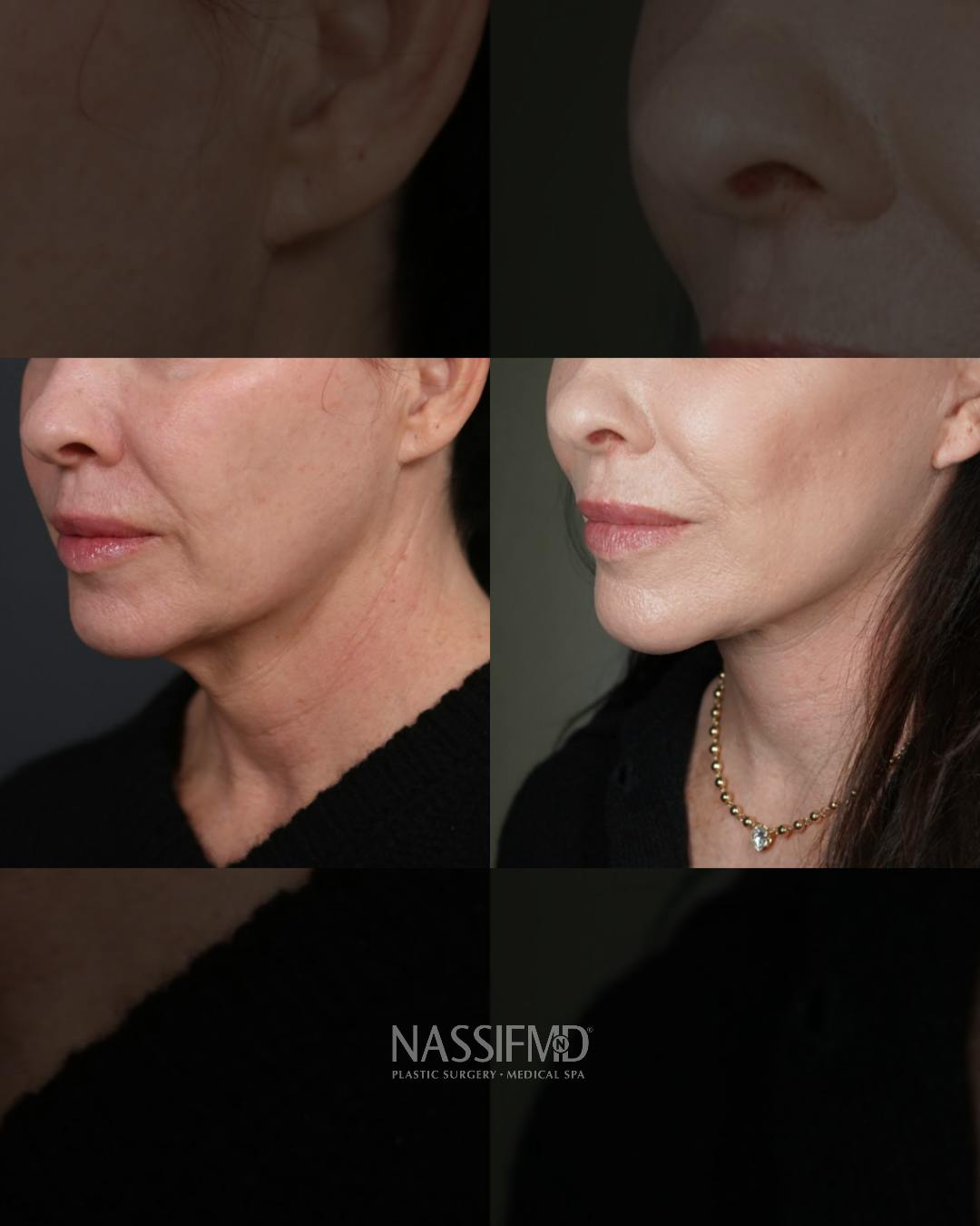 Neck Lift Before & After Gallery - Patient 279023 - Image 3
