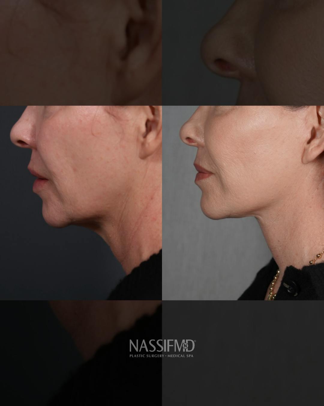 Neck Lift Before & After Gallery - Patient 279023 - Image 4