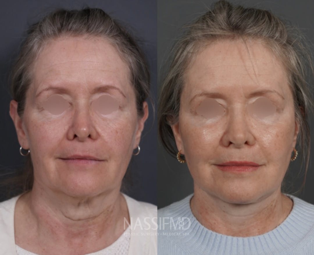 Facelift Before & After Gallery - Patient 494589 - Image 1