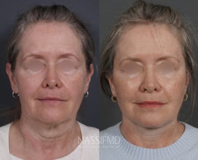 Facelift Before & After Gallery - Patient 494589 - Image 1