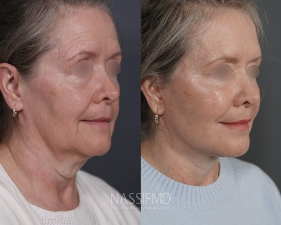 Facelift Before & After Gallery - Patient 494589 - Image 2