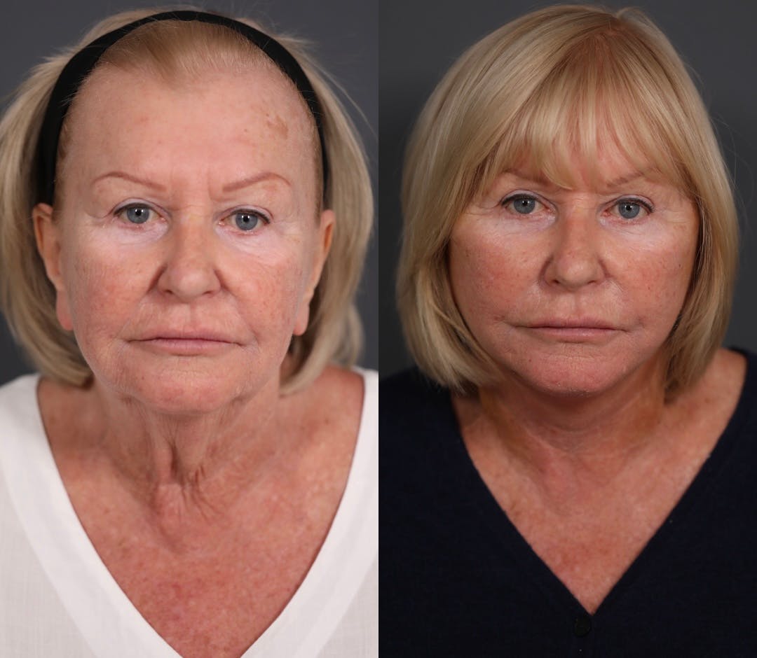 Facelift Before & After Gallery - Patient 349186 - Image 1