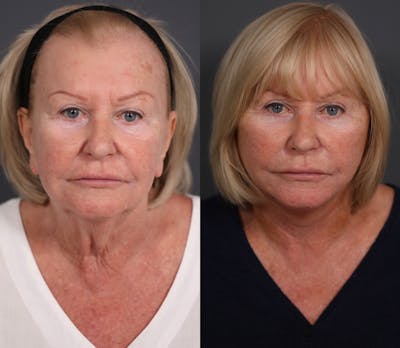 Facelift Before & After Gallery - Patient 349186 - Image 1