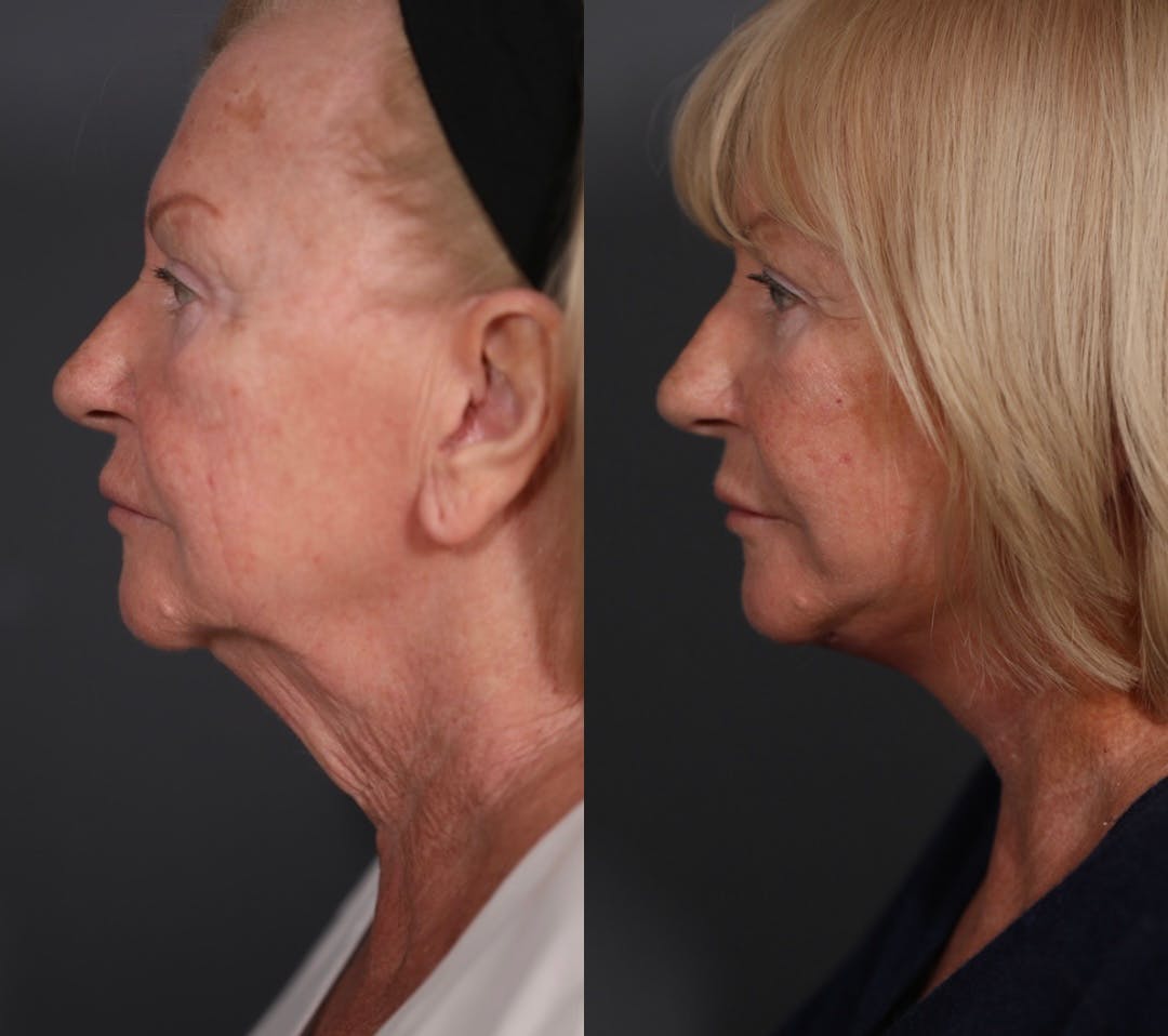 Facelift Before & After Gallery - Patient 349186 - Image 5