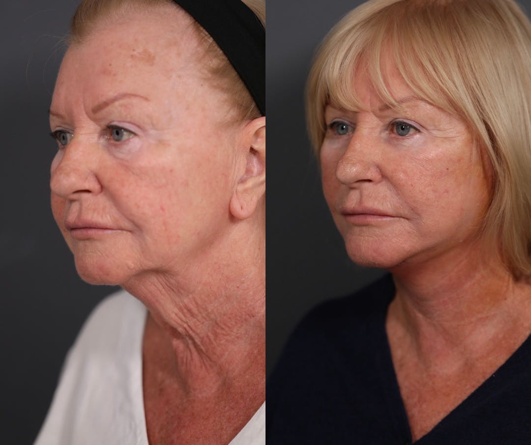 Facelift Before & After Gallery - Patient 349186 - Image 4