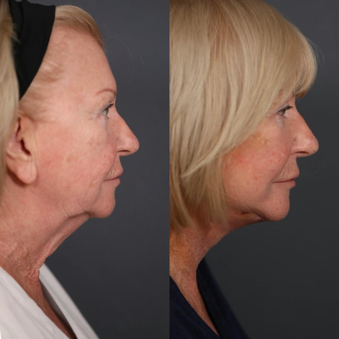 Facelift Before & After Gallery - Patient 349186 - Image 3