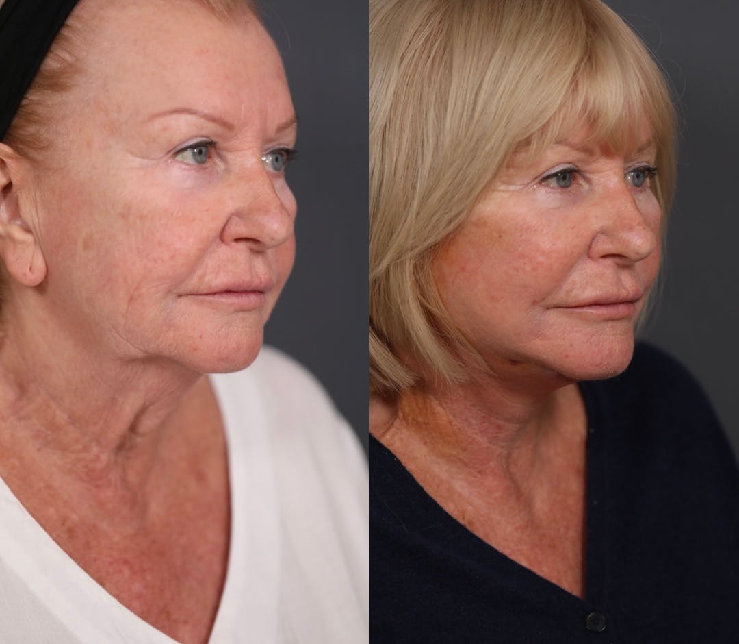 Facelift Before & After Gallery - Patient 349186 - Image 2