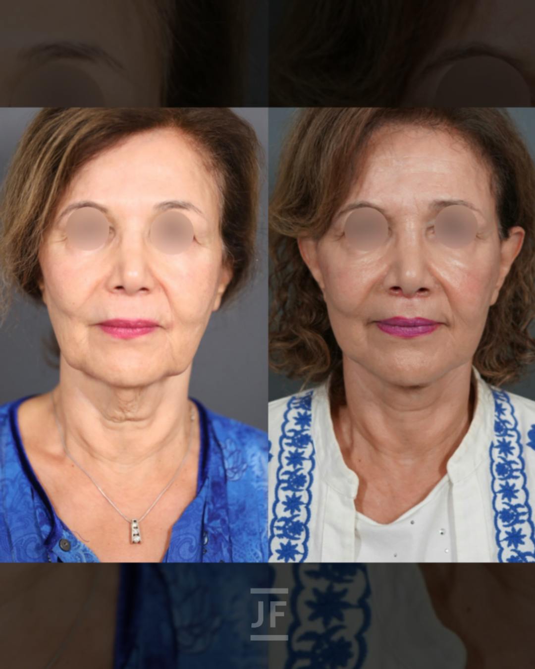 Facelift Before & After Gallery - Patient 364885 - Image 1