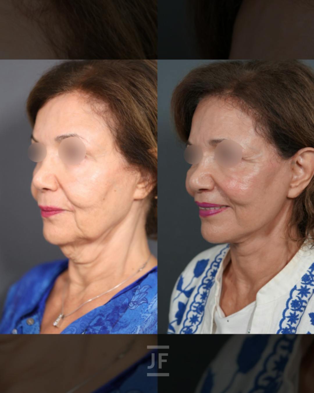 Facelift Before & After Gallery - Patient 364885 - Image 4
