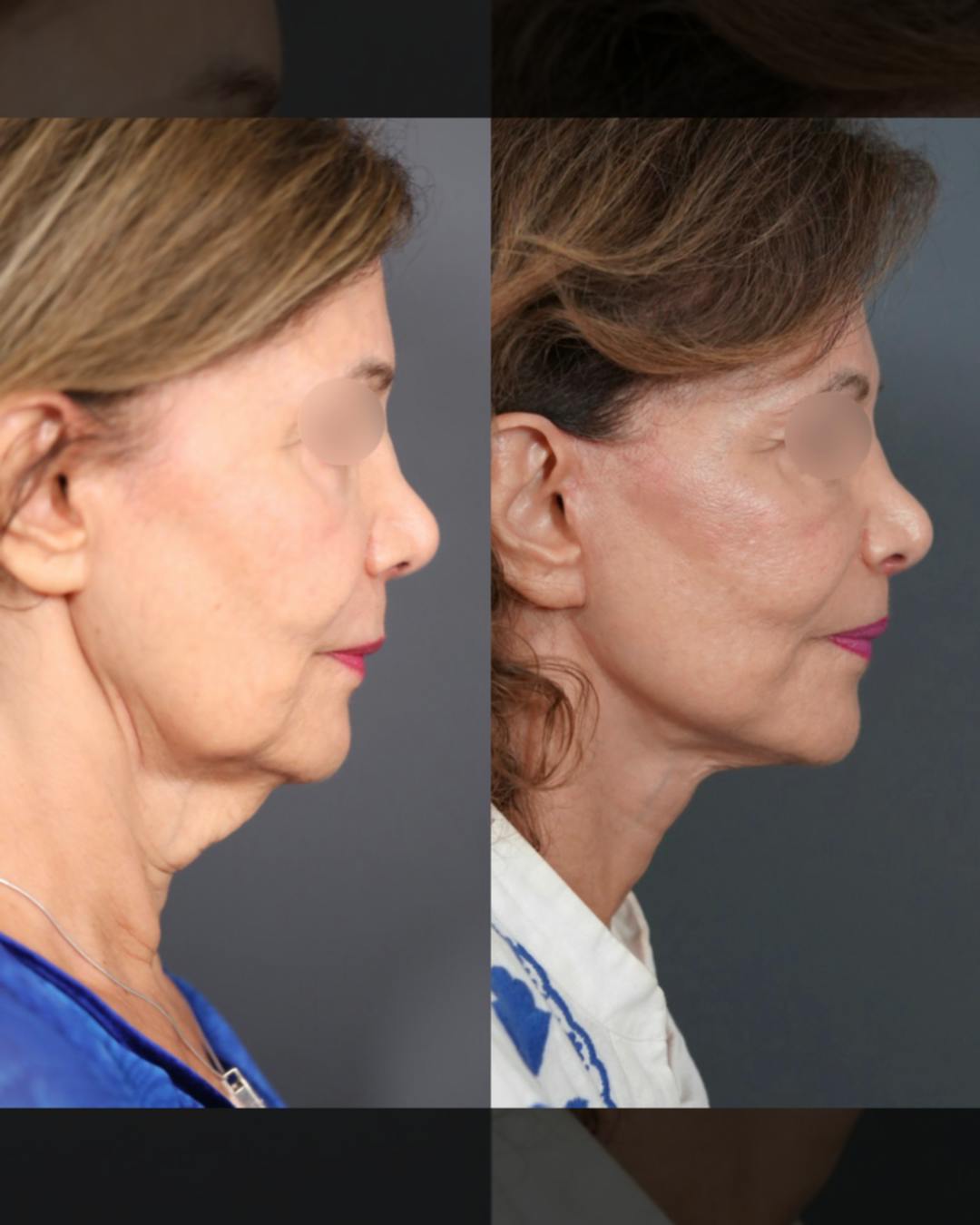 Facelift Before & After Gallery - Patient 364885 - Image 3