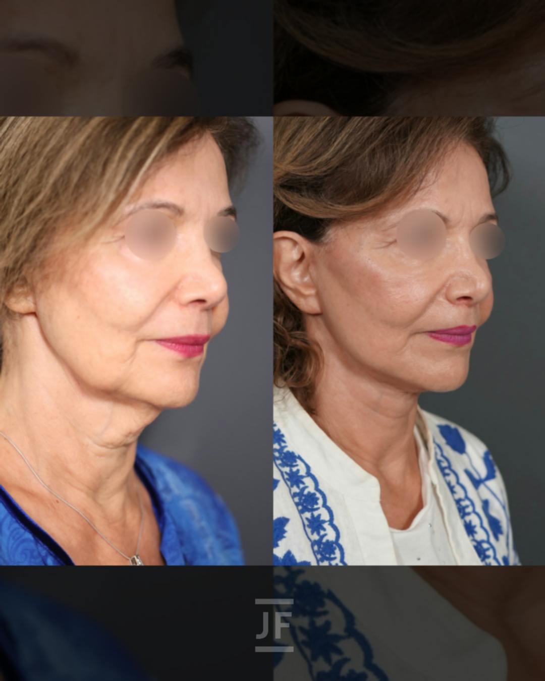 Facelift Before & After Gallery - Patient 364885 - Image 2