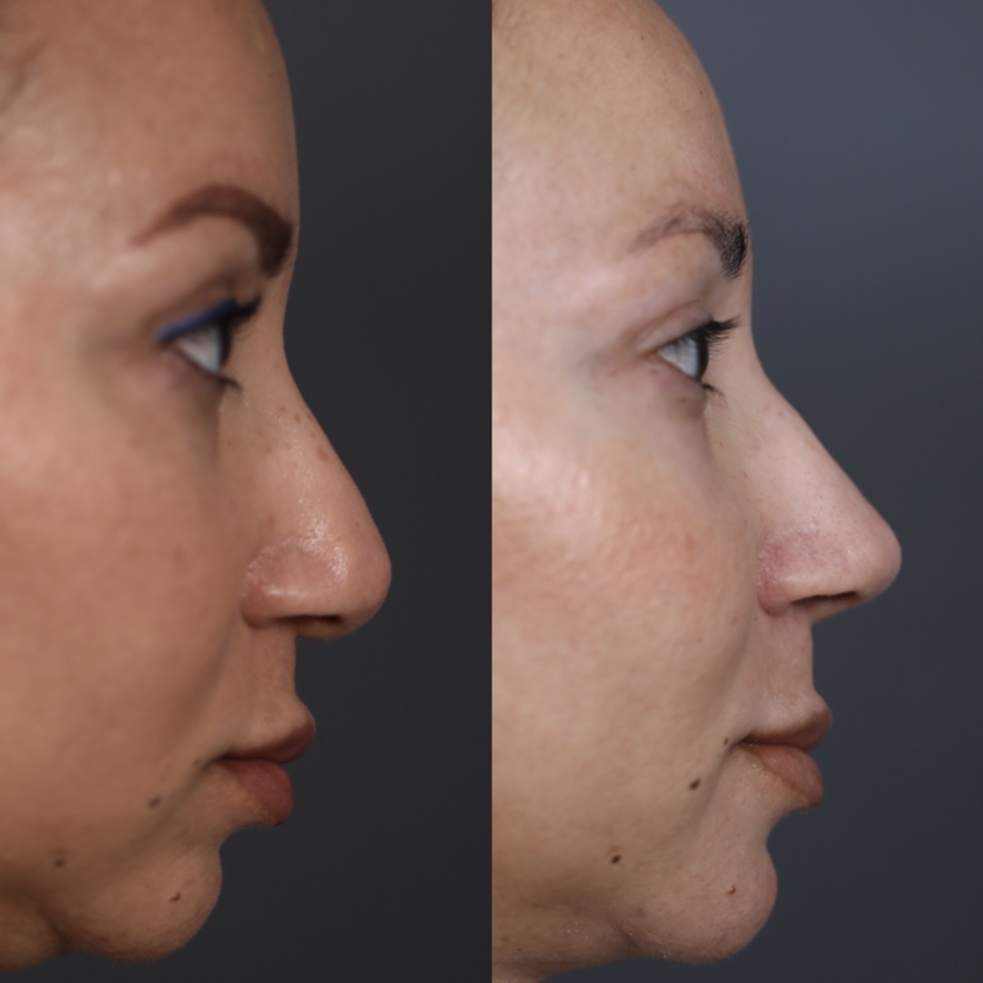 Revision Rhinoplasty Beverly Hills | Revision Nose Job Los Angeles
