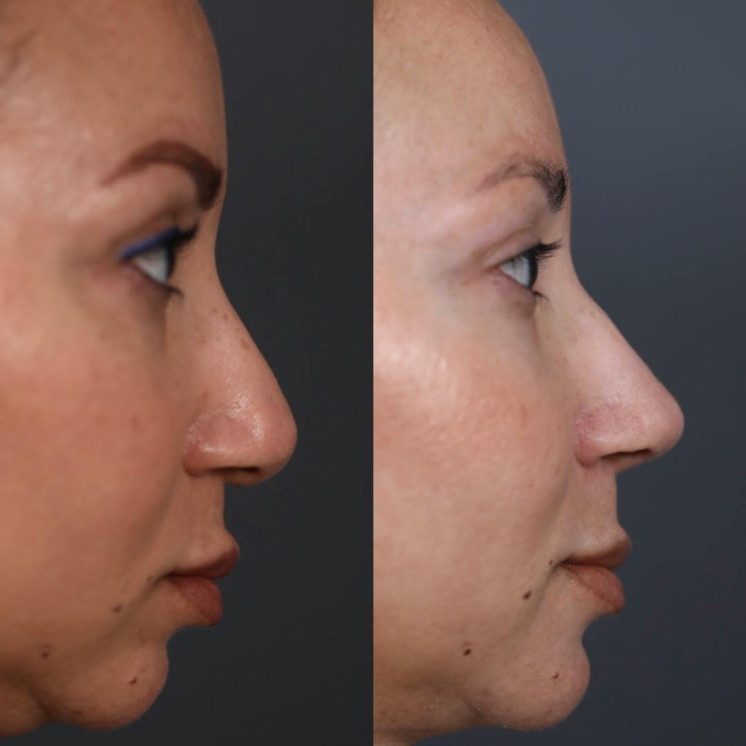 Revision Rhinoplasty Before & After Gallery - Patient 247958 - Image 1
