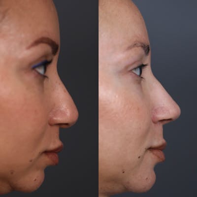 Revision Rhinoplasty Before & After Gallery - Patient 247958 - Image 1