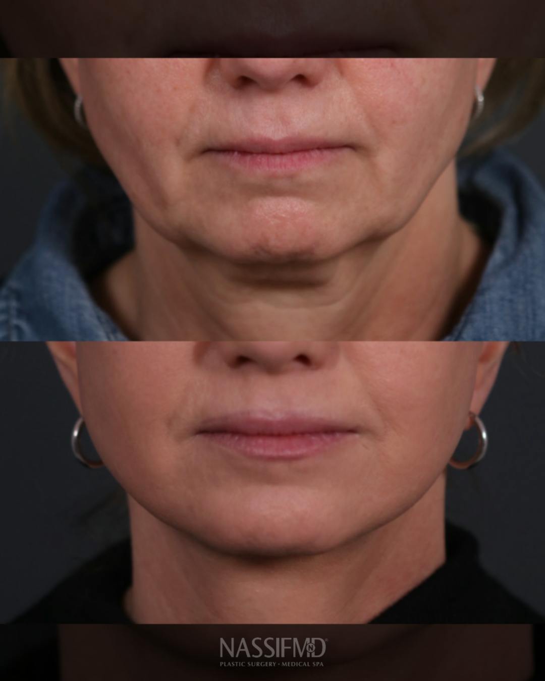 Facelift Before & After Gallery - Patient 730024 - Image 1